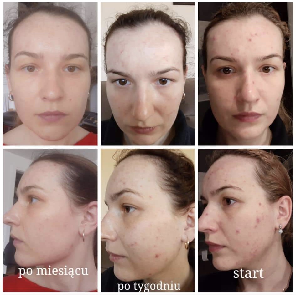 BEFORE/AFTER – Dr.Ceuracle TEA TREE PURIFINE